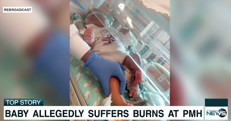 BABY ALLEGEDLY SUFFERS BURNS AT PMH